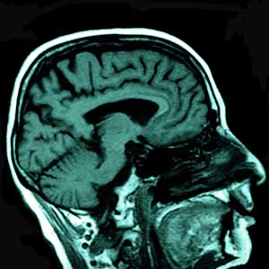 MRI - Brain