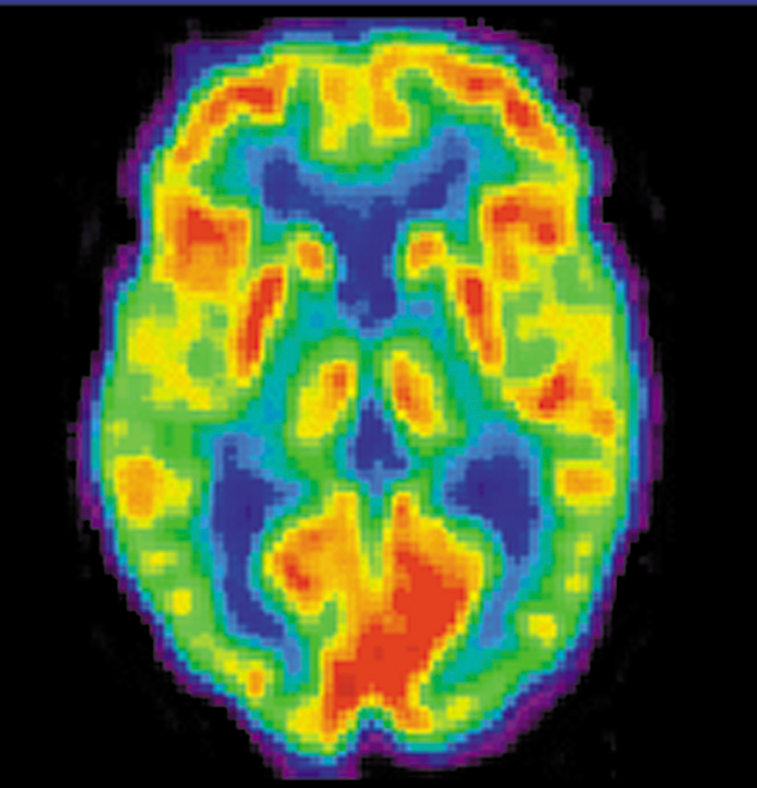 PET Scan - Brain