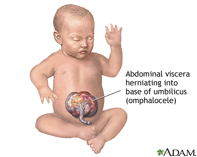 Paxil Lawyer Prozac Lawyer Zoloft Lawyer Celexa Lawyer SSRI Birth Defect Lawsuit SSRI Attorney - Omphalocele - A.D.A.M 2012