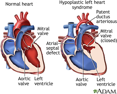 Paxil Lawyer SSRI Lawsuit SSRI Birth Defect Attorney Hypoplastic left heart syndrome - ADAM 2012