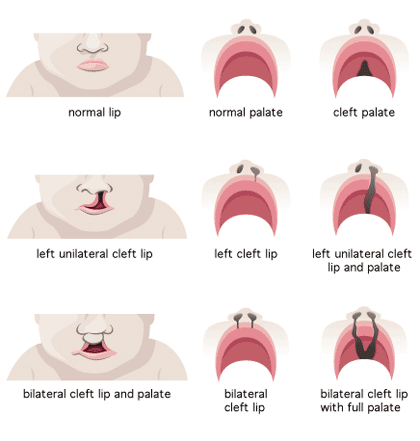 Prozac Lawyer Celexa Lawyer SSRI Birth Defect Lawsuit SSRI Attorney - Cleft Palate - KidsHealth.org