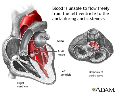 Zoloft Lawyer SSRI Lawsuit SSRI Birth Defect Attorney Aortic Stenosis - ADAM 2012