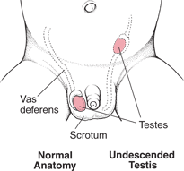 Paxil Lawyer Celexa Lawyer SSRI Birth Defect Lawsuit SSRI Attorney - Undescended Testes