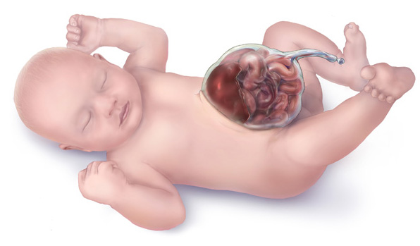 Zoloft Lawyer SSRI Birth Defect Lawsuit SSRI Attorney - Omphalocele