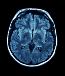 mri2