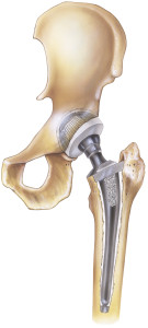 Hip Implant