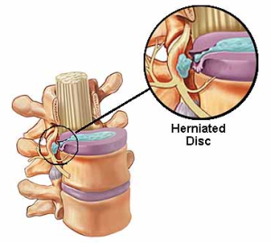 lumbar disc herniation with impingementpinge
