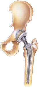Hip Implant