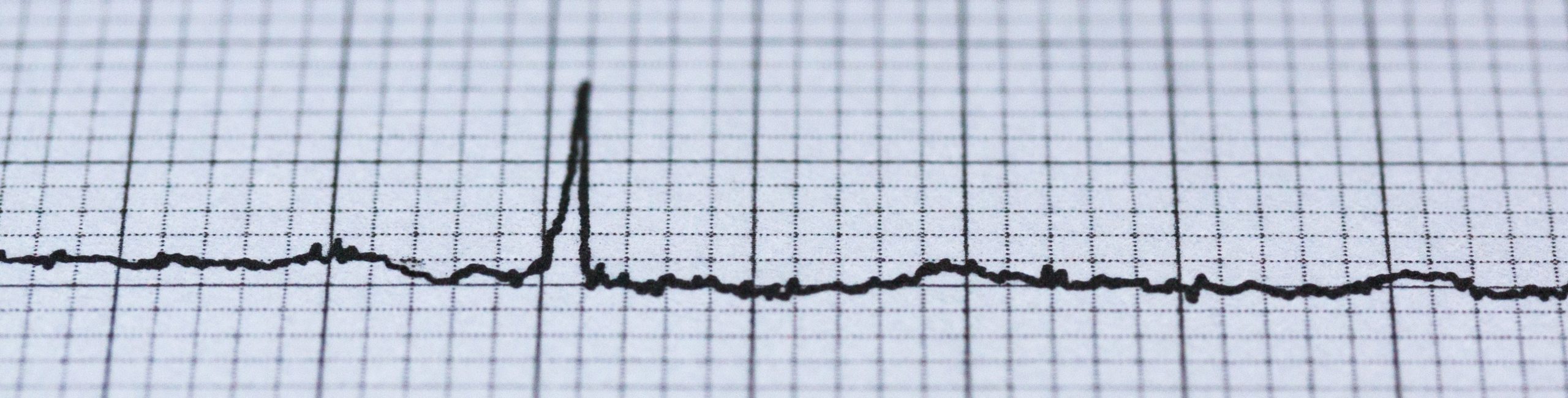 Single heart beat E K G