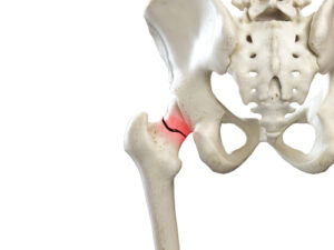 What to Do If You've Broken Your Hip in a Slip and Fall Accident in Port St. Lucie
