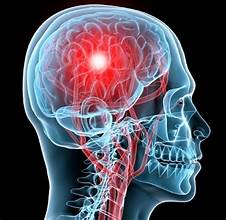 https-www-atlantainjurylawblog-com-files-2023-11-brain-concussion-jpg