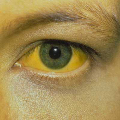 Hepatitis-b-d-c-Jaundice-ppt