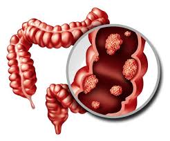 coloncancer
