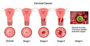cervicalcancer