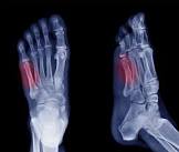 jonesfracture