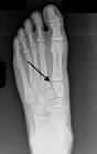 lisfranc