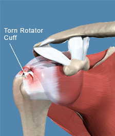 https-www-newyorkinjurycasesblog-com-files-2025-11-rotator_cuff-jpg