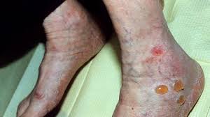 diabeticblisters