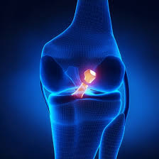 ACLtear