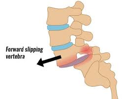spondylolisthesis