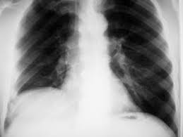 fractureddiaphragm
