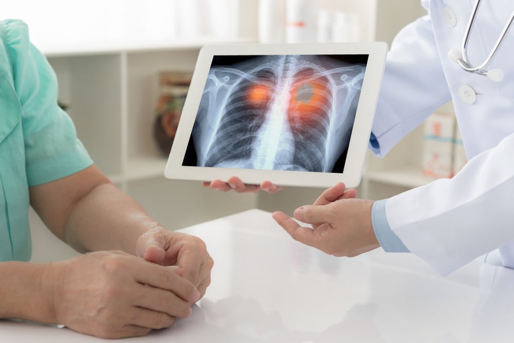 The 9/11 Community Has an Increased Cancer Risk and Need for Early Cancer Detection