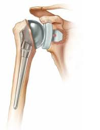 shoulderreplacement